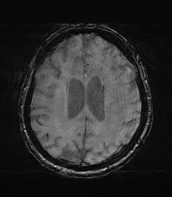 File:Behavioral variant frontotemporal dementia and late onset schizophrenia (Radiopaedia 52197-58083 Axial SWI 49).png