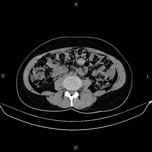 Benign adrenal adenoma (Radiopaedia 84166-99440 Axial non-contrast 55).jpg