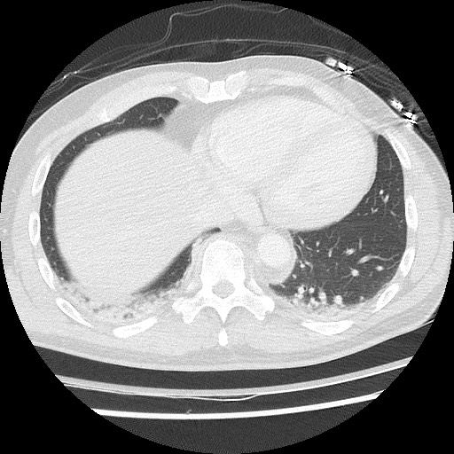 Benign post-traumatic pseudopneumoperitoneum (Radiopaedia 71199-81495 Axial lung window 54).jpg