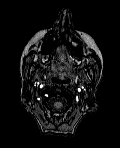 Berry aneurysm of the terminal internal carotid artery (Radiopaedia 88286-104918 Axial TOF 9).jpg