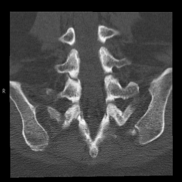 Bertolotti syndrome (Radiopaedia 24864-25128 Coronal bone window 33).jpg