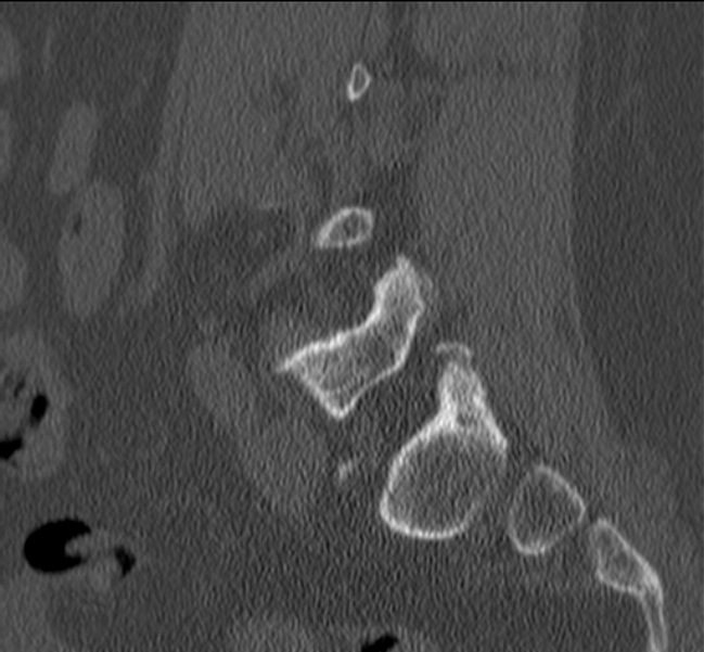 Bertolotti syndrome (Radiopaedia 24864-25128 Sagittal bone window 40).jpg