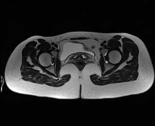 File:Bicornuate bicollis uterus (Radiopaedia 61626-69616 Axial T2 29).jpg
