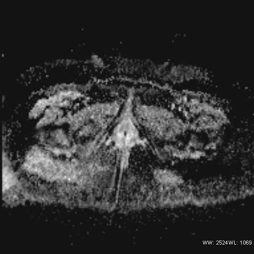 File:Bicornuate uterus- on MRI (Radiopaedia 49206-54297 Axial ADC 24).jpg