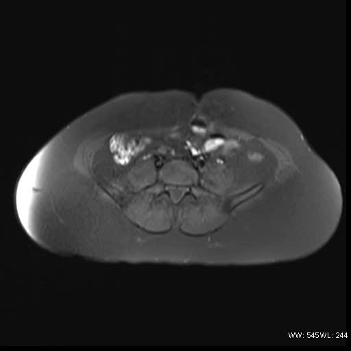 File:Bicornuate uterus- on MRI (Radiopaedia 49206-54297 Axial T1 fat sat 1).jpg
