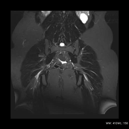 File:Bicornuate uterus- on MRI (Radiopaedia 49206-54297 Coronal STIR 16).jpg