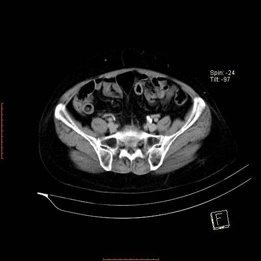 File:Bifid ureter (Radiopaedia 47604-52253 Axial C+ delayed 20).jpg