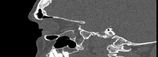 Bilateral Ectopic Infraorbital Nerves (Radiopaedia 49006-54084 Sagittal bone window 15).jpg