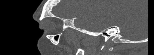 Bilateral Ectopic Infraorbital Nerves (Radiopaedia 49006-54084 Sagittal bone window 3).jpg
