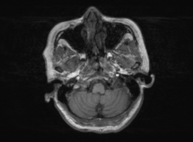 File:Bilateral PCA territory infarction - different ages (Radiopaedia 46200-51784 Axial T1 331).jpg