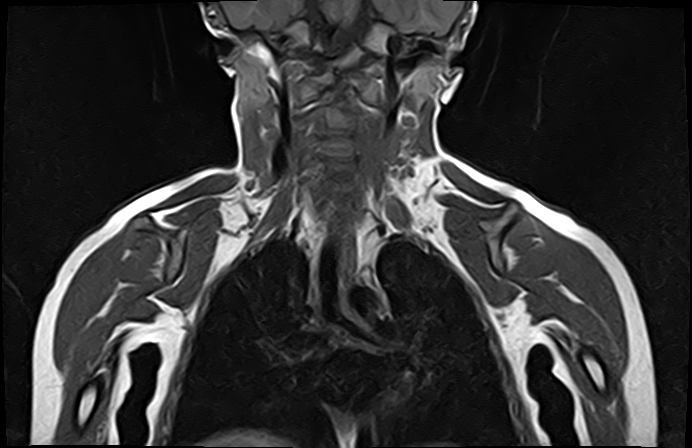 File:Bilateral Sprengel deformity with Klippel-Feil syndrome (Radiopaedia 66395-75650 Coronal T1 12).jpg