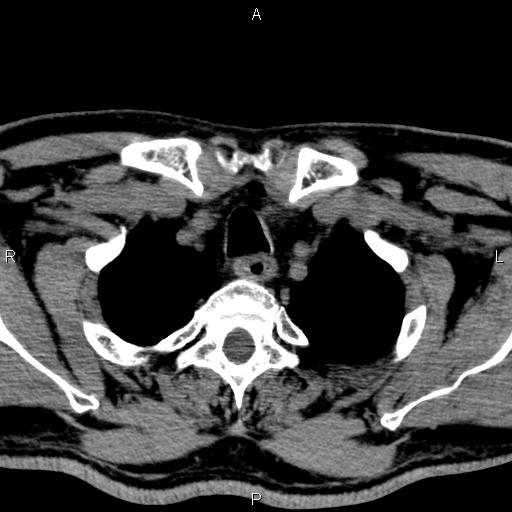 Bilateral Warthin tumors (Radiopaedia 84034-99263 Axial non-contrast 62).jpg