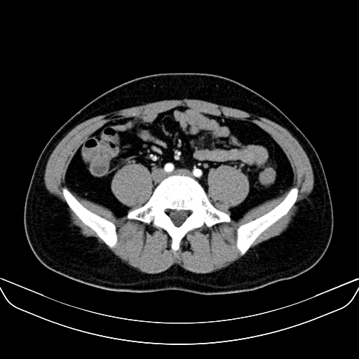 Bilateral accessory renal arteries with mild pelvi-ureteric junction (PUJ) obstruction (Radiopaedia 66357-75596 A 44).jpg