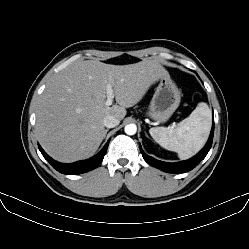 Bilateral accessory renal arteries with mild pelvi-ureteric junction (PUJ) obstruction (Radiopaedia 66357-75596 A 8).jpg