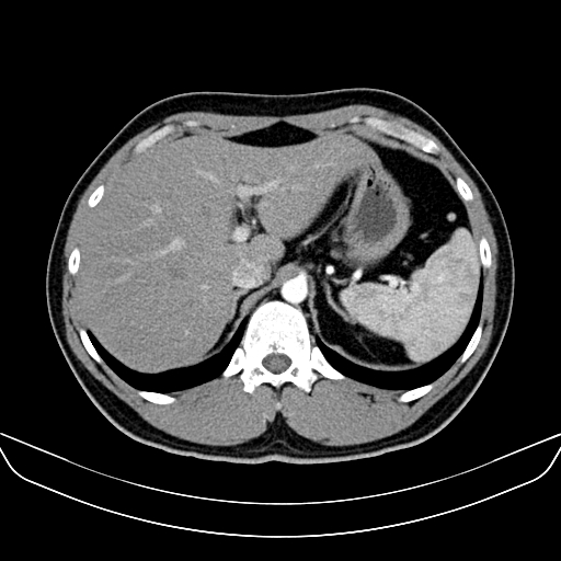 Bilateral accessory renal arteries with mild pelvi-ureteric junction (PUJ) obstruction (Radiopaedia 66357-75596 A 9).jpg