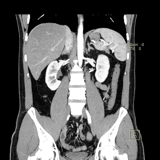 File:Bilateral accessory renal arteries with mild pelvi-ureteric junction (PUJ) obstruction (Radiopaedia 66357-75596 B 24).jpg
