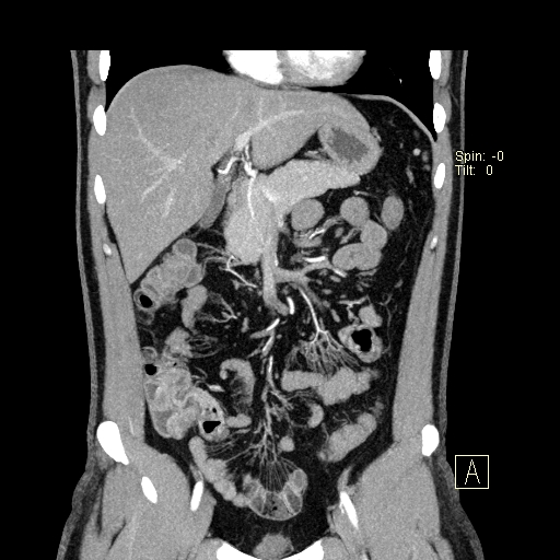 File:Bilateral accessory renal arteries with mild pelvi-ureteric junction (PUJ) obstruction (Radiopaedia 66357-75596 B 3).jpg
