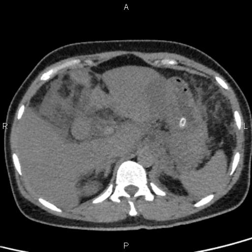 Bilateral adrenal gland hyperenhancement in pancreatitis (Radiopaedia 86642-102753 Axial non-contrast 25).jpg