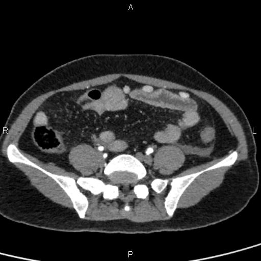 File:Bilateral adrenal gland hyperenhancement in pancreatitis (Radiopaedia 86642-102753 B 95).jpg