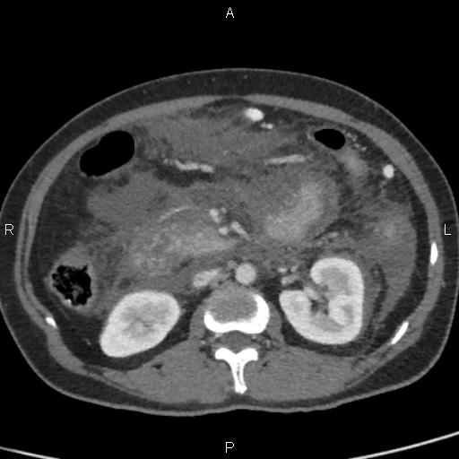 Bilateral adrenal gland hyperenhancement in pancreatitis (Radiopaedia 86642-102753 E 48).jpg