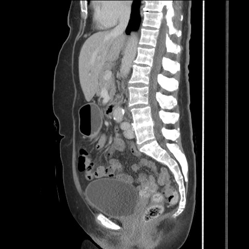 Bilateral adrenal granulocytic sarcomas (chloromas) (Radiopaedia 78375-91007 C 72).jpg