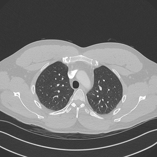 File:Bilateral atelectasis (Radiopaedia 48666-53675 Axial lung window 28).jpg