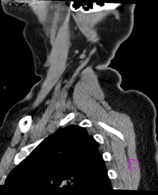Bilateral atlanto-occipital assimilation (Radiopaedia 28350-28603 D 72).jpg