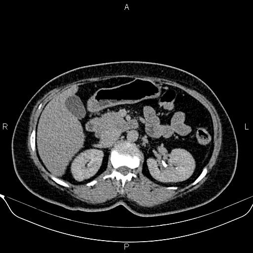 Bilateral benign adrenal adenomas (Radiopaedia 86912-103124 Axial C+ delayed 48).jpg