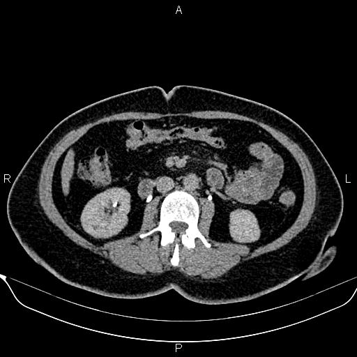 Bilateral benign adrenal adenomas (Radiopaedia 86912-103124 Axial C+ delayed 74).jpg