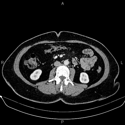 Bilateral benign adrenal adenomas (Radiopaedia 86912-103124 B 57).jpg