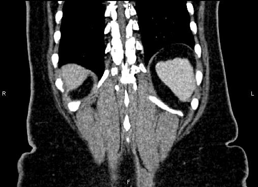 Bilateral benign adrenal adenomas (Radiopaedia 86912-103124 D 57).jpg