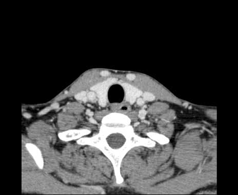 Bilateral carotid body tumors (Radiopaedia 61841-69870 Axial Post contrast 95).jpg