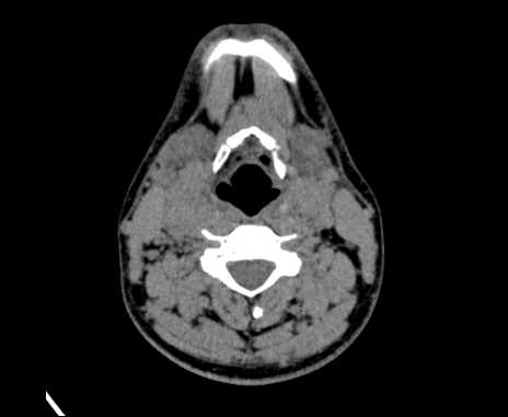 Bilateral carotid body tumors (Radiopaedia 61841-69870 Axial non-contrast 55).jpg