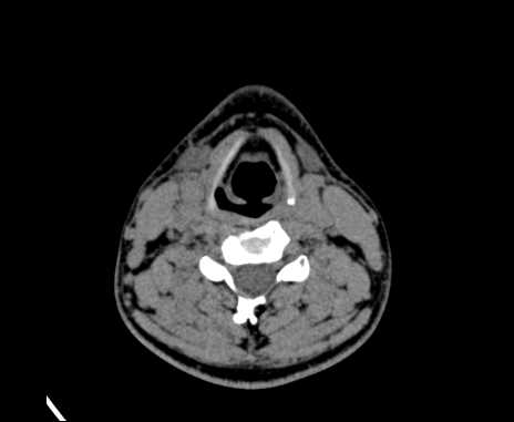 Bilateral carotid body tumors (Radiopaedia 61841-69870 Axial non-contrast 63).jpg