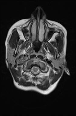 File:Bilateral carotid body tumors and right jugular paraganglioma (Radiopaedia 20024-20060 Axial 65).jpg