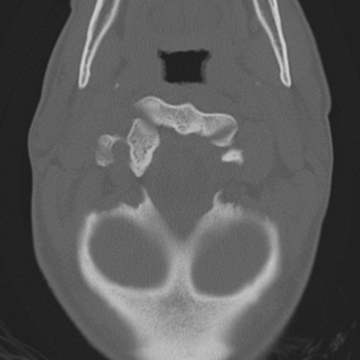 Bilateral locked facets (Radiopaedia 33850-35016 Axial bone window 8).png