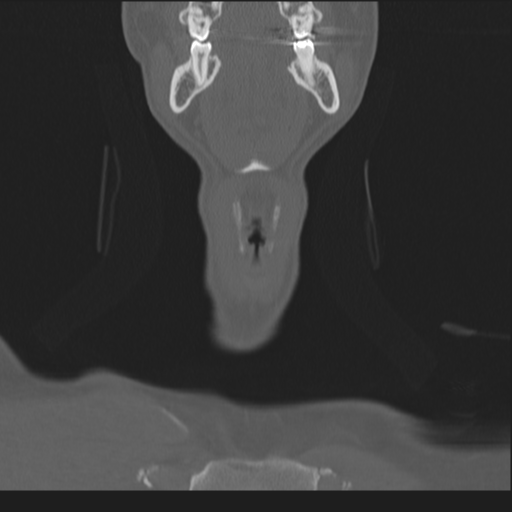 Bilateral locked facets (Radiopaedia 33850-35016 Coronal bone window 10).png