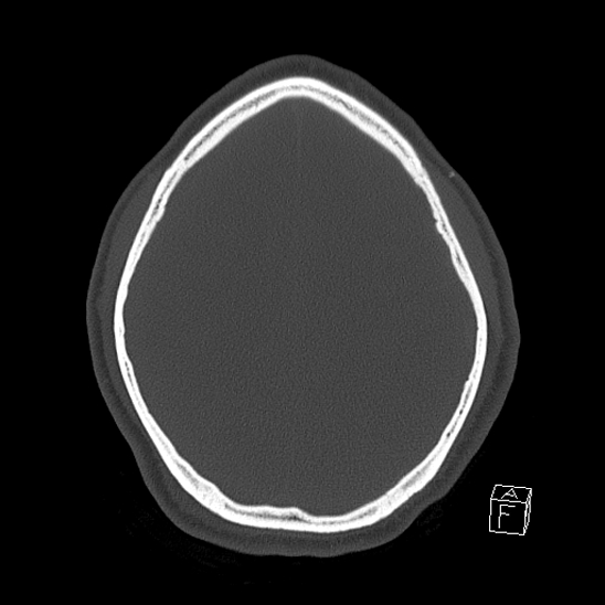 Bilateral occipital condyle fracture (type 2) (Radiopaedia 87675-104089 Axial bone window 101).jpg
