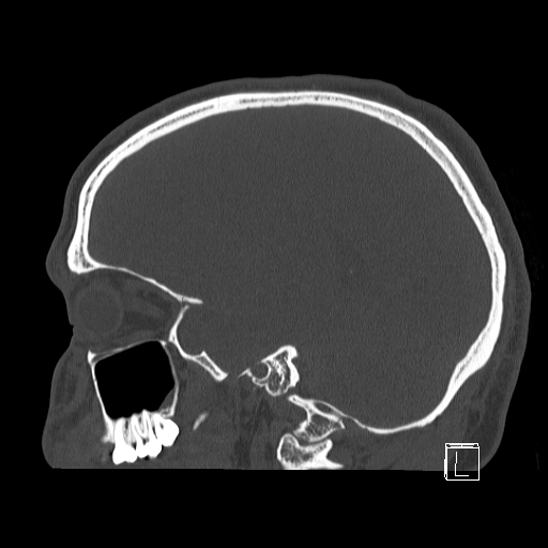 Bilateral occipital condyle fracture (type 2) (Radiopaedia 87675-104089 Sagittal bone window 32).jpg