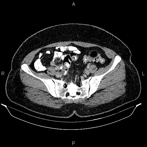 Bilateral ovarian dermoid cysts (Radiopaedia 85785-101603 A 83).jpg