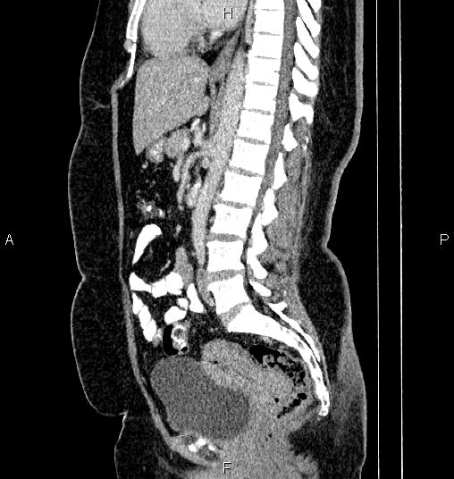 Bilateral ovarian dermoid cysts (Radiopaedia 85785-101603 D 48).jpg