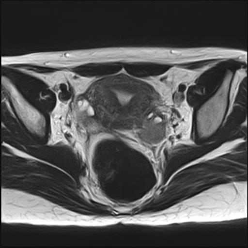 File:Bilateral ovarian endometriomas (Radiopaedia 87085-103347 Axial T2 11).jpg