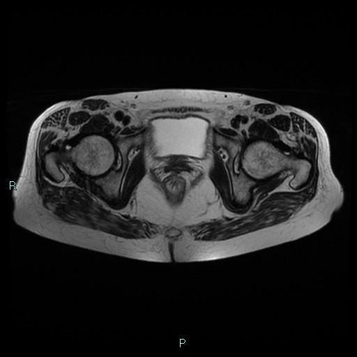 File:Bilateral ovarian fibroma (Radiopaedia 44568-48293 Axial T2 23).jpg