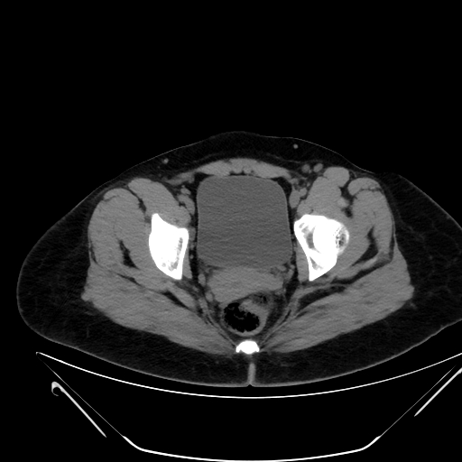 File:Bilateral ovarian mature cystic teratomas (Radiopaedia 79373-92457 Axial non-contrast 77).jpg