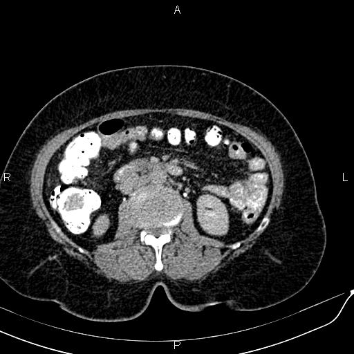 Bilateral ovarian serous cystadenocarcinoma (Radiopaedia 86062-101989 Axial C+ delayed 29).jpg