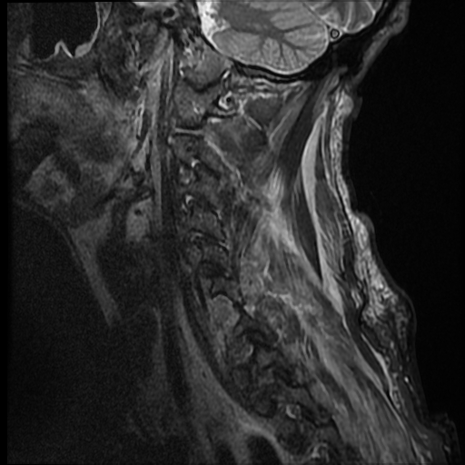 File:Bilateral perched facets with cord injury (Radiopaedia 45587-49714 Sagittal STIR 1).jpg