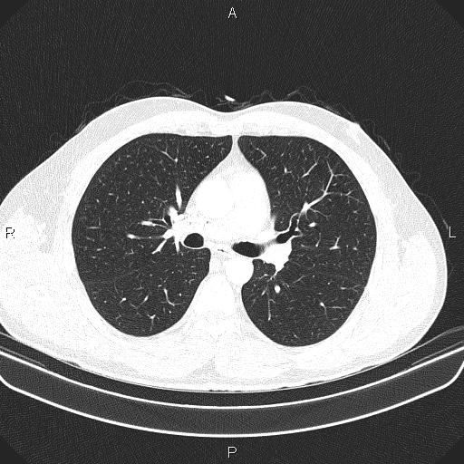 File:Bilateral pulmonary AVM (Radiopaedia 83134-97505 Axial lung window 32).jpg