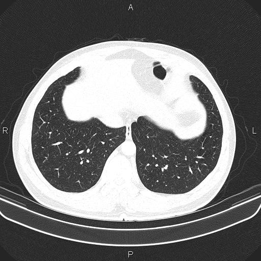 File:Bilateral pulmonary AVM (Radiopaedia 83134-97505 Axial lung window 58).jpg