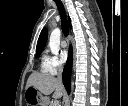 Bilateral pulmonary AVM (Radiopaedia 83134-97505 D 59).jpg