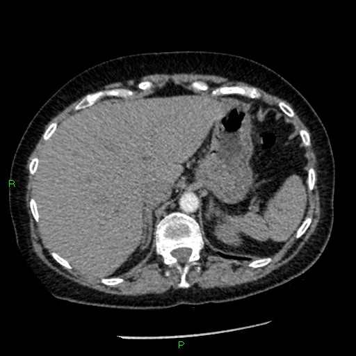 File:Bilateral pulmonary emboli (Radiopaedia 32700-33669 Axial C+ CTPA 101).jpg